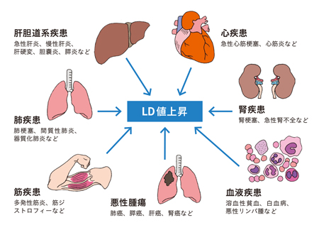 妊娠中のLDH